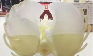 3D打印醫療領域應用-右位心模型